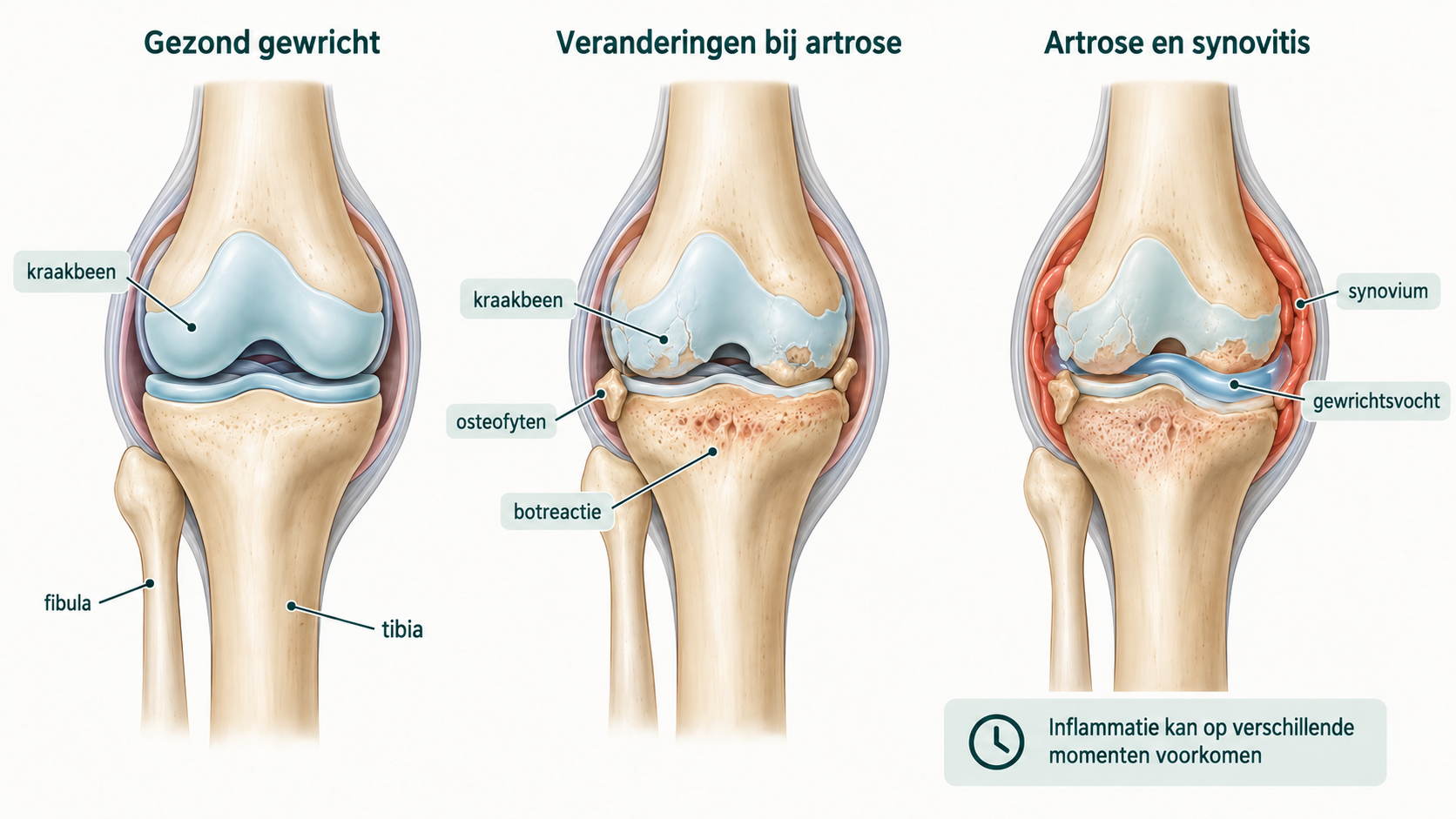 Vergelijking van een gezond kniegewricht, veranderingen bij artrose en artrose met ontstoken gewrichtsslijmvlies en extra gewrichtsvocht