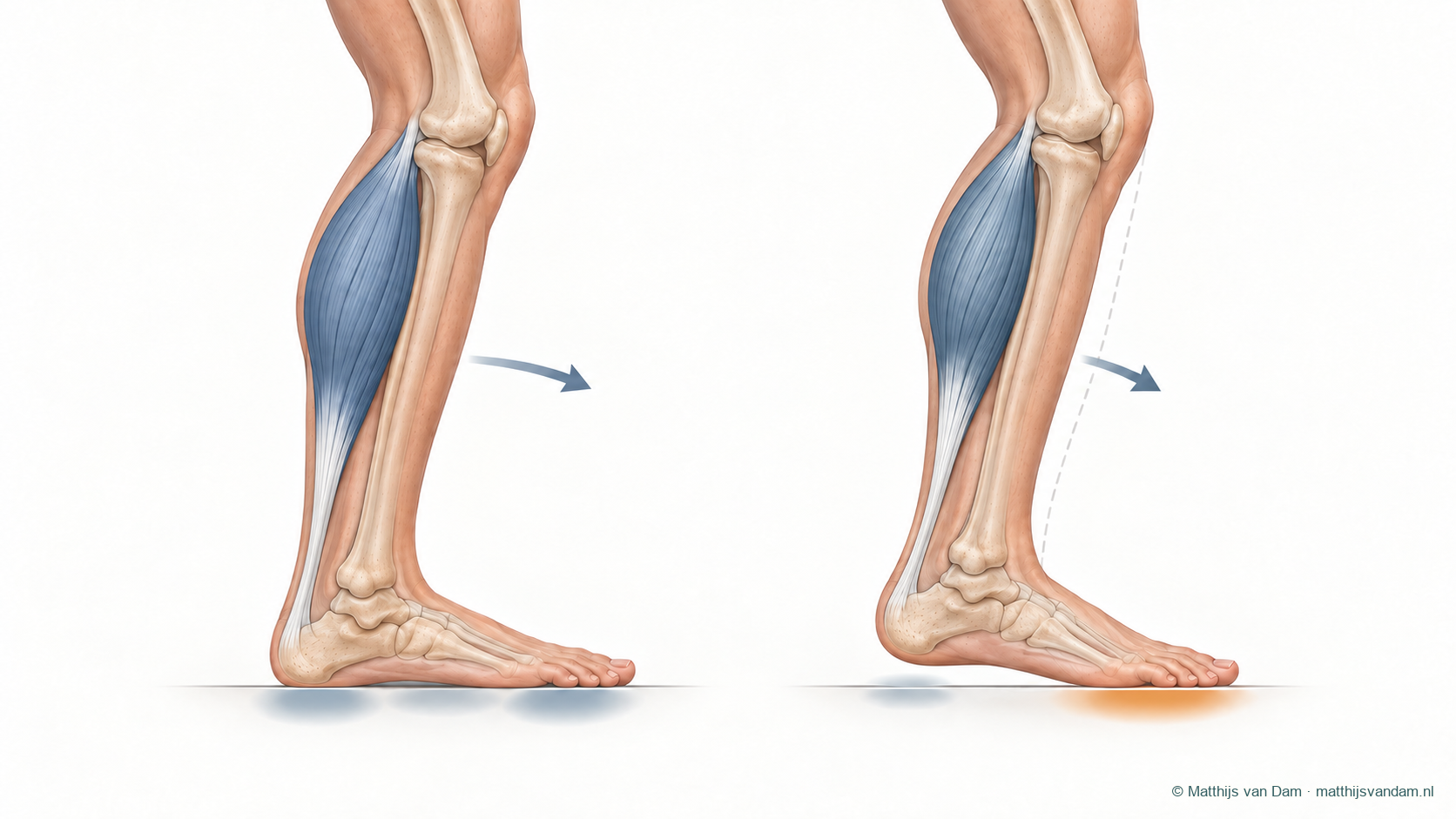 Schematische vergelijking in zijaanzicht met in beide benen alleen de gastrocnemius blauw gemarkeerd: normale enkelbeweging en beperkte enkelbeweging met meer belasting onder de voorvoet
