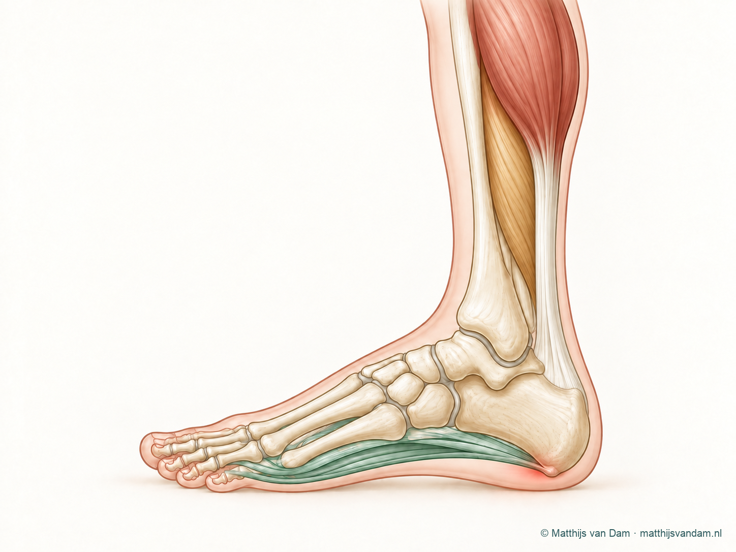 Schematisch zijaanzicht van kuit en voet met de gastrocnemius, soleus, achillespees, plantaire fascie, een klein botuitsteeksel onder het hielbeen en een subtiel gemarkeerd pijngebied