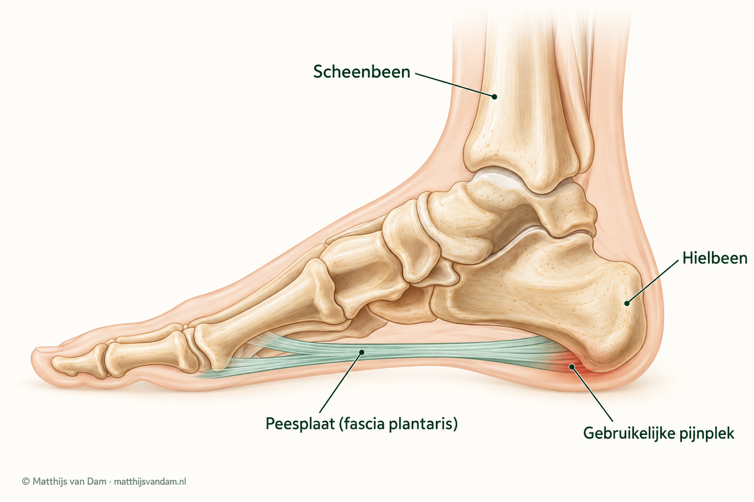 Anatomische illustratie van de voet van opzij, met scheenbeen, hielbeen en de groen weergegeven peesplaat onder de voet. De aanhechting onder de hiel is gemarkeerd als gebruikelijke pijnplek.