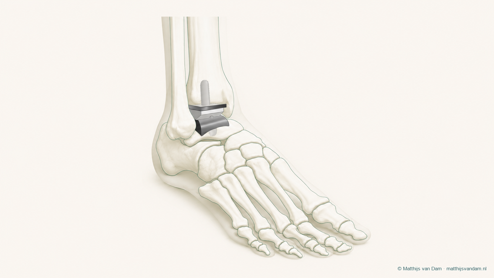 Anatomische illustratie van een enkelprothese tussen scheenbeen en sprongbeen
